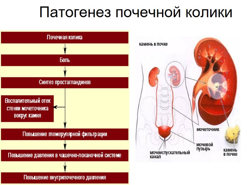 Патогенез почечной колики